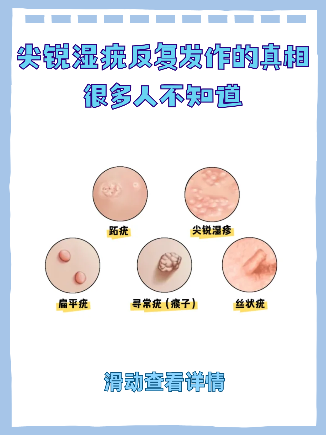 尖锐湿疣怎么治疗才能根治不传染_(尖锐湿疣怎么治疗才能根治不传染家人)